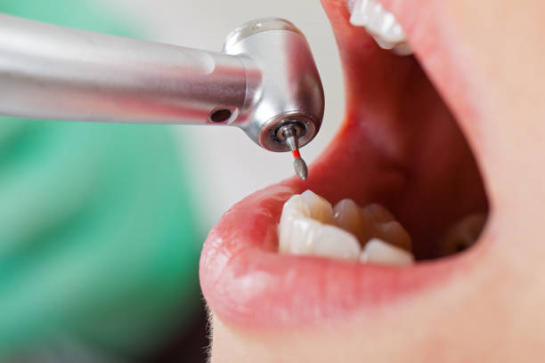 Best Emergency Tooth Extraction in Audubon Park, KY